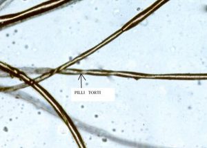 Microscopic examination of hair revealed classical sign of pili torti, a typical sign of Menkes disease. Also known as "Twisted hairs," pili torti is characterized by short and brittle hairs that appear flattened and twisted when viewed through a microscope. Courtesy BioMed Central.