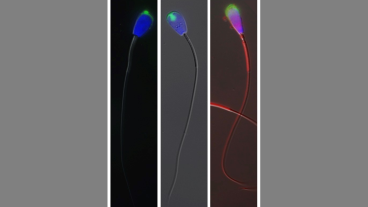Images of sperm captured through image-based flow cytometry show irregularities that can affect fertility. From left to right, the images show a knobbed acrosome, nuclear vacuoles and mitochondrial aplasia and piriform head.